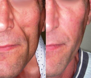 Lipoatrofia Facial
